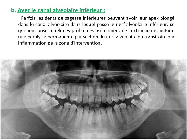 b. Avec le canal alvéolaire inférieur : Parfois les dents de sagesse inférieures peuvent