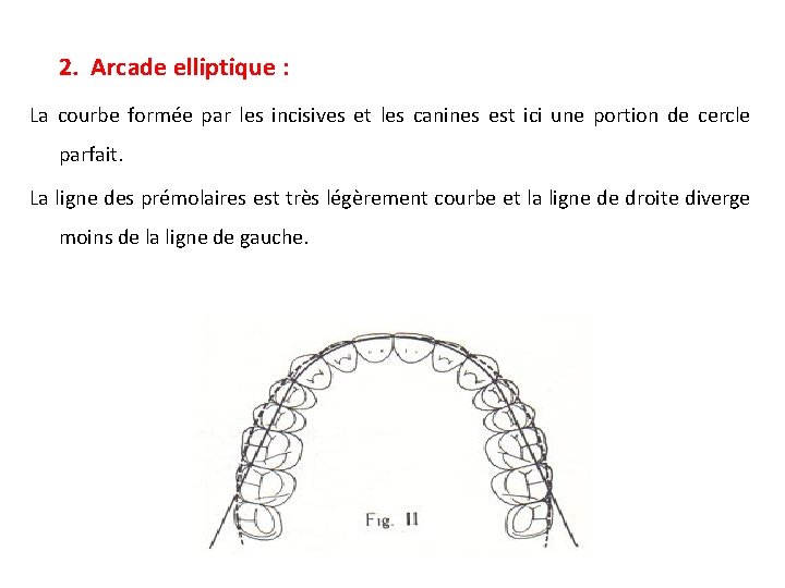 2. Arcade elliptique : La courbe formée par les incisives et les canines est