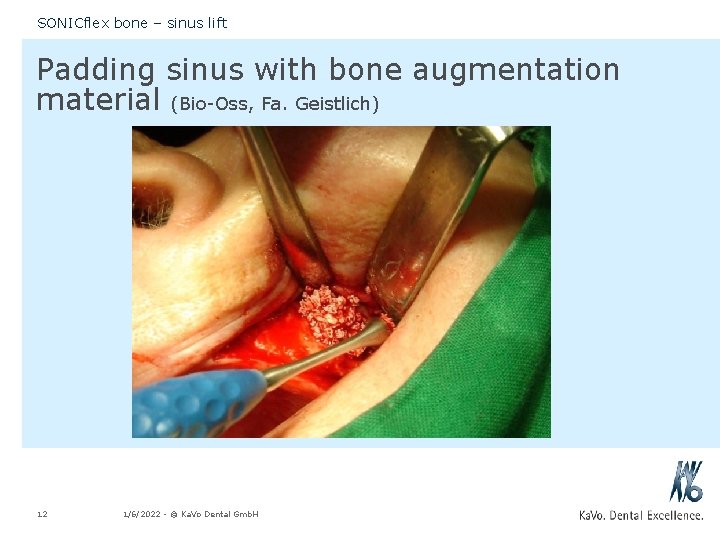 SONICflex bone – sinus lift Padding sinus with bone augmentation material (Bio-Oss, Fa. Geistlich)