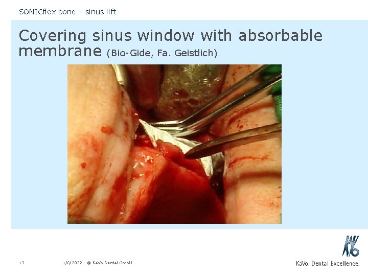 SONICflex bone – sinus lift Covering sinus window with absorbable membrane (Bio-Gide, Fa. Geistlich)