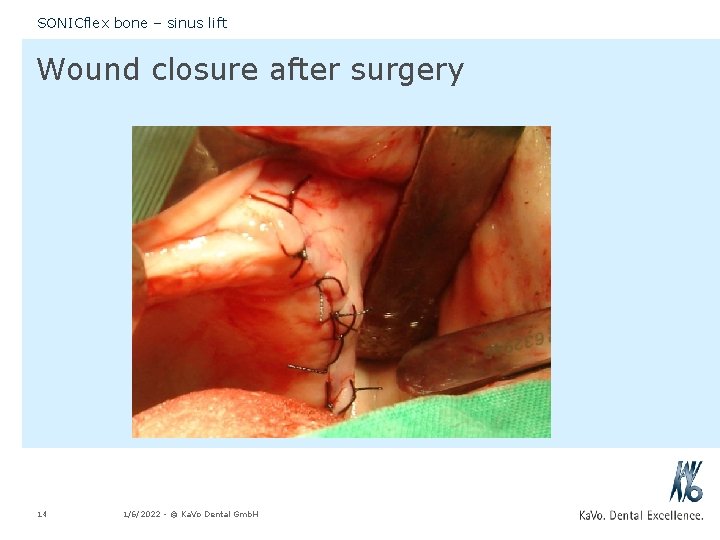 SONICflex bone – sinus lift Wound closure after surgery 14 1/6/2022 - © Ka.