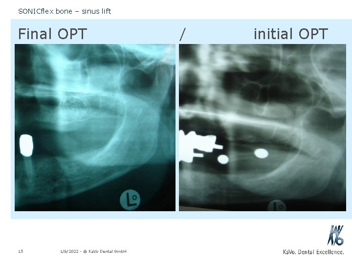 SONICflex bone – sinus lift Final OPT 15 1/6/2022 - © Ka. Vo Dental