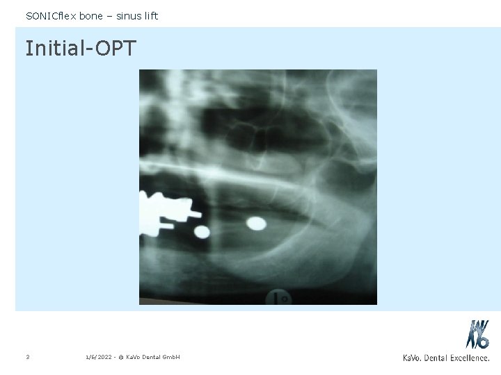 SONICflex bone – sinus lift Initial-OPT 3 1/6/2022 - © Ka. Vo Dental Gmb.