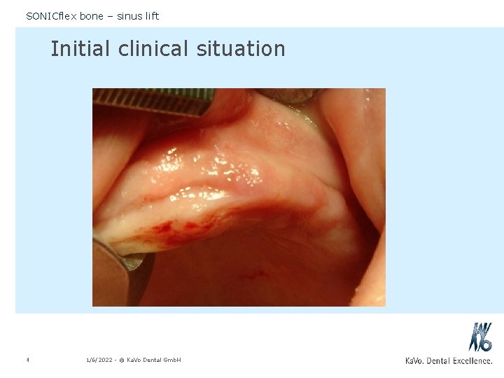 SONICflex bone – sinus lift Initial clinical situation 4 1/6/2022 - © Ka. Vo