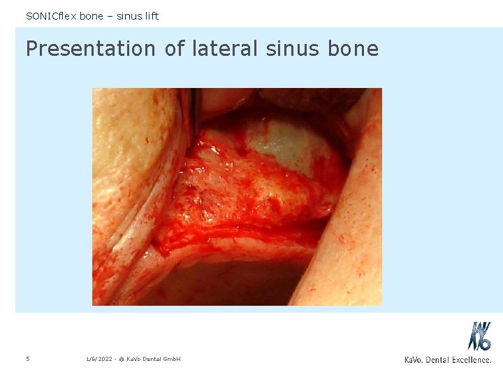 SONICflex bone – sinus lift Presentation of lateral sinus bone 5 1/6/2022 - ©