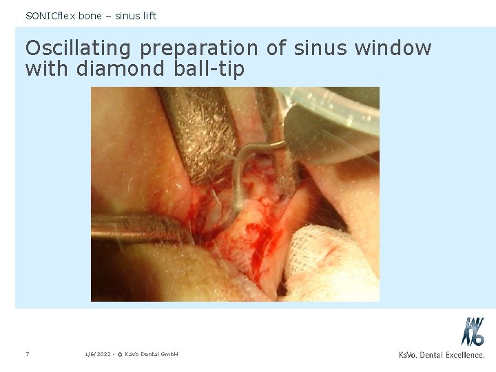 SONICflex bone – sinus lift Oscillating preparation of sinus window with diamond ball-tip 7