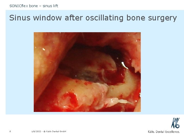 SONICflex bone – sinus lift Sinus window after oscillating bone surgery 8 1/6/2022 -
