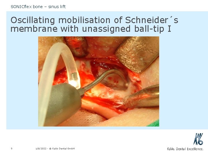 SONICflex bone – sinus lift Oscillating mobilisation of Schneider´s membrane with unassigned ball-tip I