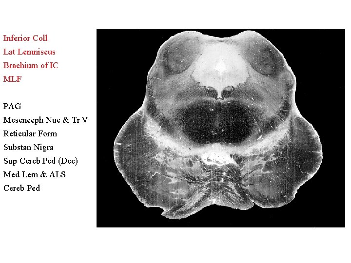 Inferior Coll Lat Lemniscus Brachium of IC MLF PAG Mesenceph Nuc & Tr V