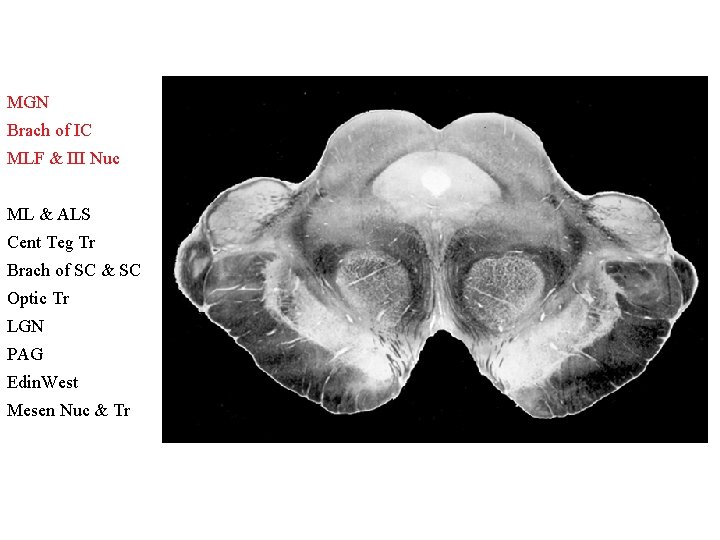 MGN Brach of IC MLF & III Nuc ML & ALS Cent Teg Tr