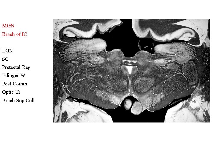 MGN Brach of IC LGN SC Pretectal Reg Edinger W Post Comm Optic Tr