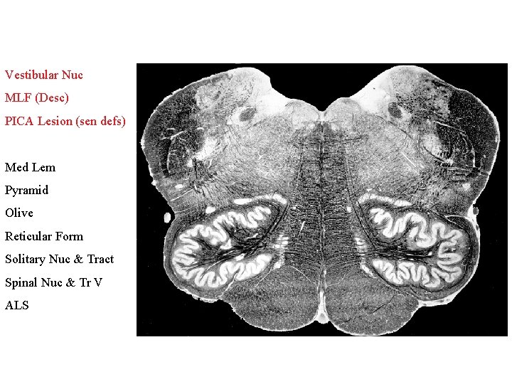 Vestibular Nuc MLF (Desc) PICA Lesion (sen defs) Med Lem Pyramid Olive Reticular Form