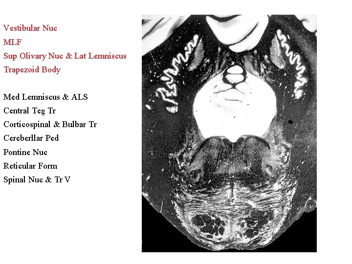 Vestibular Nuc MLF Sup Olivary Nuc & Lat Lemniscus Trapezoid Body Med Lemniscus &