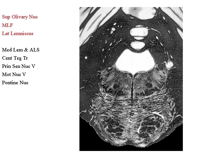 Sup Olivary Nuc MLF Lat Lemniscus Med Lem & ALS Cent Teg Tr Prin