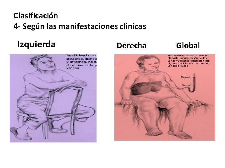 Clasificación 4 - Según las manifestaciones clinicas Izquierda Derecha Global 