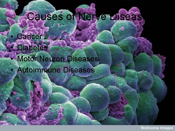 Causes of Nerve Disease • • Cancer Diabetes Motor Neuron Diseases Autoimmune Diseases 