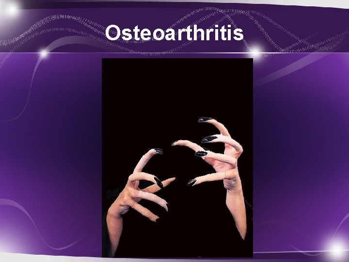 Osteoarthritis 