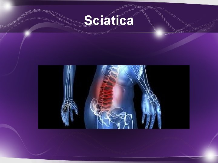 Sciatica 