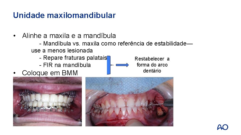 Unidade maxilomandibular • Alinhe a maxila e a mandíbula - Mandíbula vs. maxila como