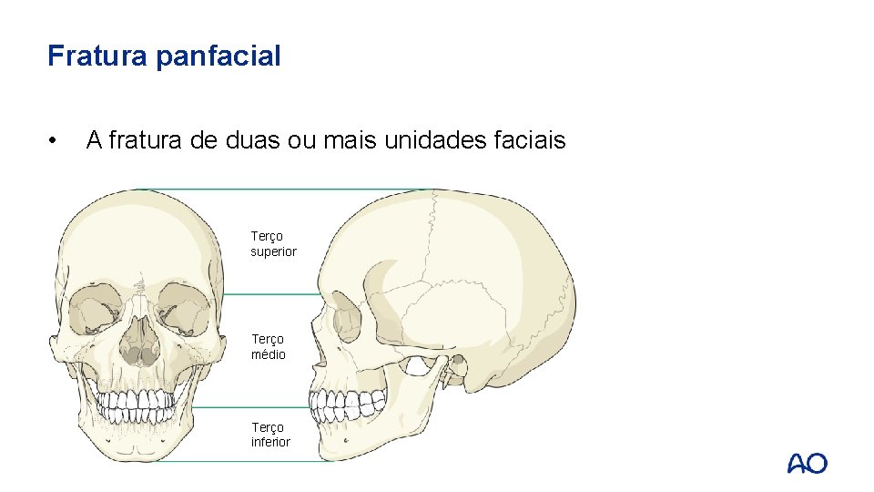 Fratura panfacial • A fratura de duas ou mais unidades faciais Upper Terço third