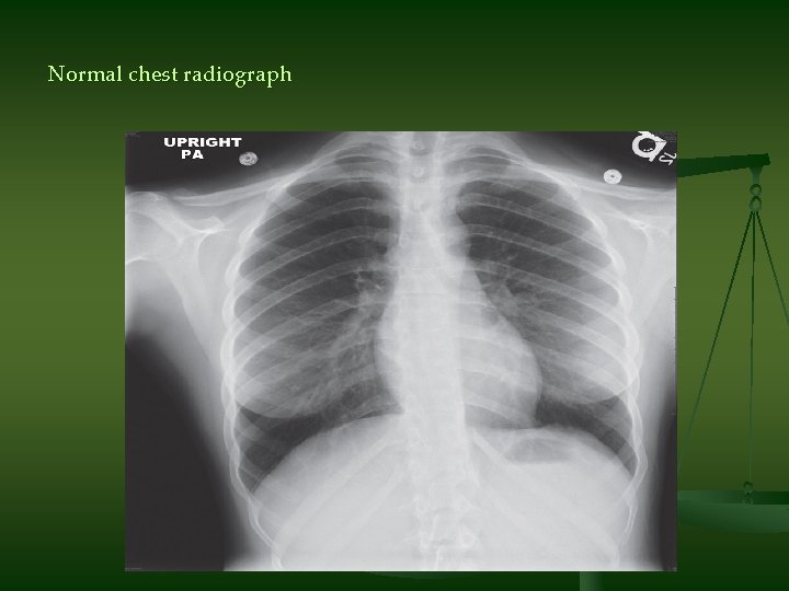 Normal chest radiograph 