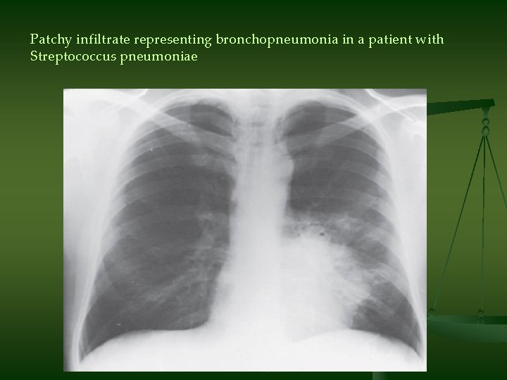 Patchy infiltrate representing bronchopneumonia in a patient with Streptococcus pneumoniae 