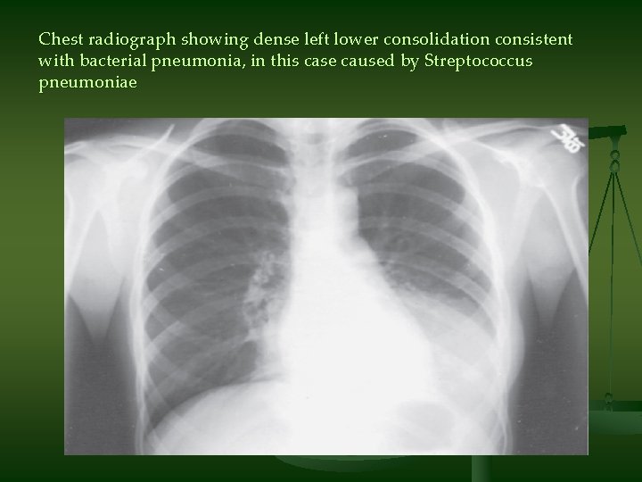 Chest radiograph showing dense left lower consolidation consistent with bacterial pneumonia, in this case