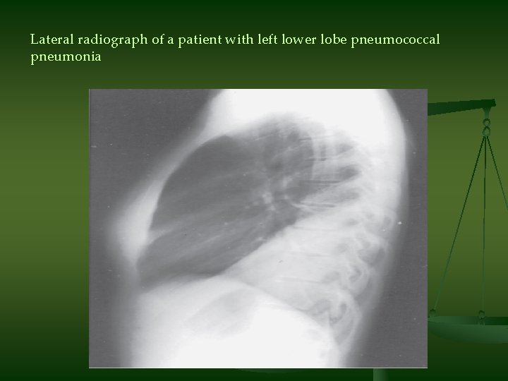 Lateral radiograph of a patient with left lower lobe pneumococcal pneumonia 