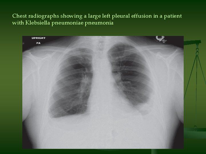 Chest radiographs showing a large left pleural effusion in a patient with Klebsiella pneumoniae