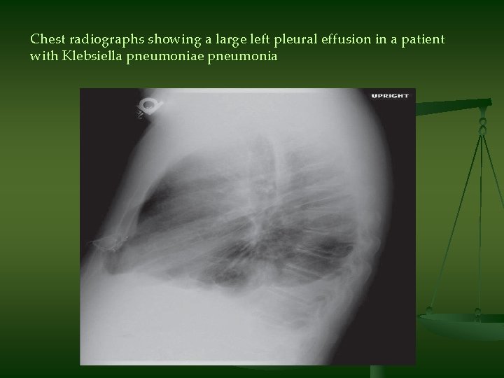 Chest radiographs showing a large left pleural effusion in a patient with Klebsiella pneumoniae