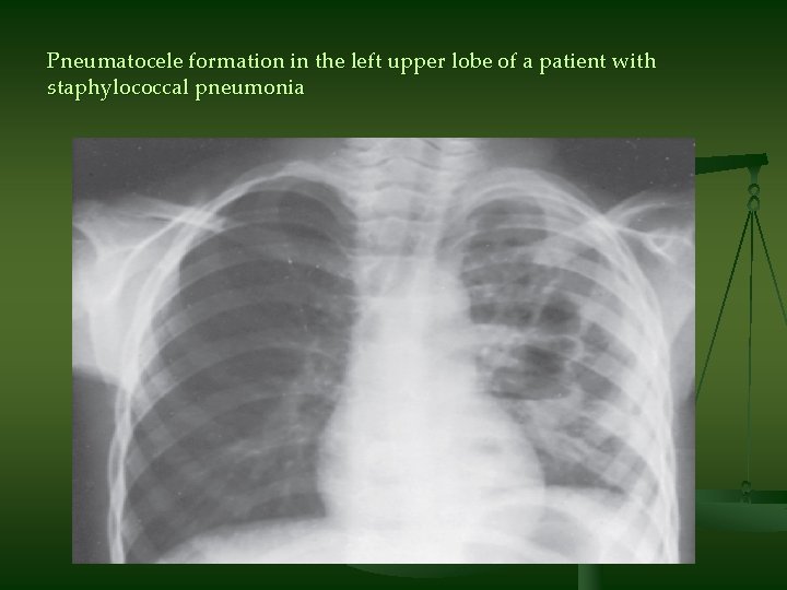 Pneumatocele formation in the left upper lobe of a patient with staphylococcal pneumonia 