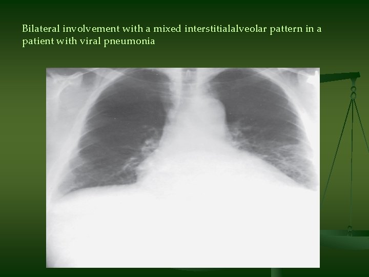 Bilateral involvement with a mixed interstitialalveolar pattern in a patient with viral pneumonia 
