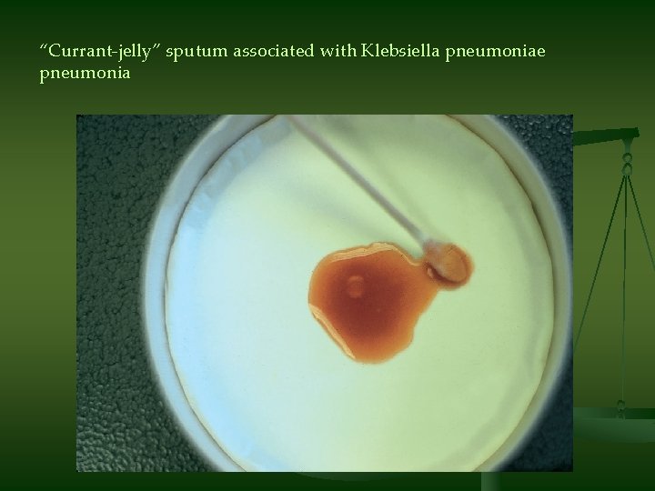 “Currant-jelly” sputum associated with Klebsiella pneumoniae pneumonia 