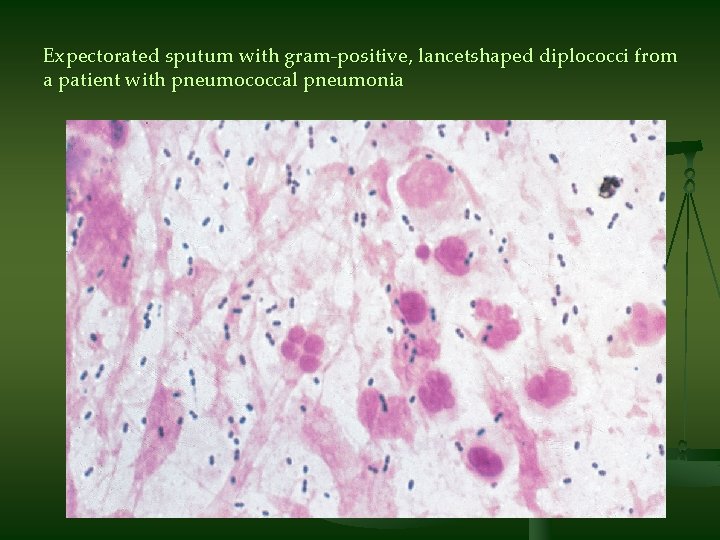 Expectorated sputum with gram-positive, lancetshaped diplococci from a patient with pneumococcal pneumonia 