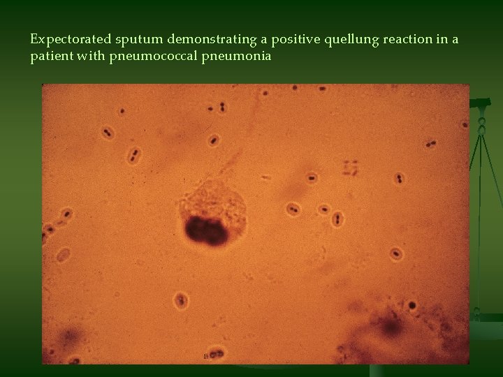 Expectorated sputum demonstrating a positive quellung reaction in a patient with pneumococcal pneumonia 