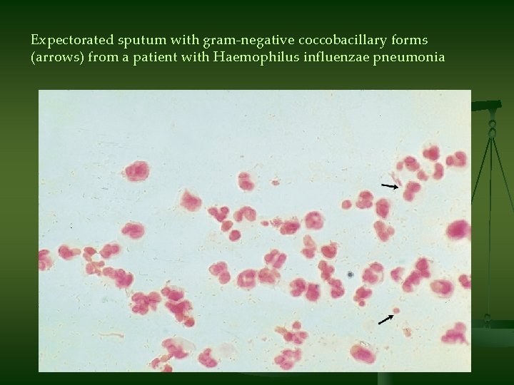 Expectorated sputum with gram-negative coccobacillary forms (arrows) from a patient with Haemophilus influenzae pneumonia