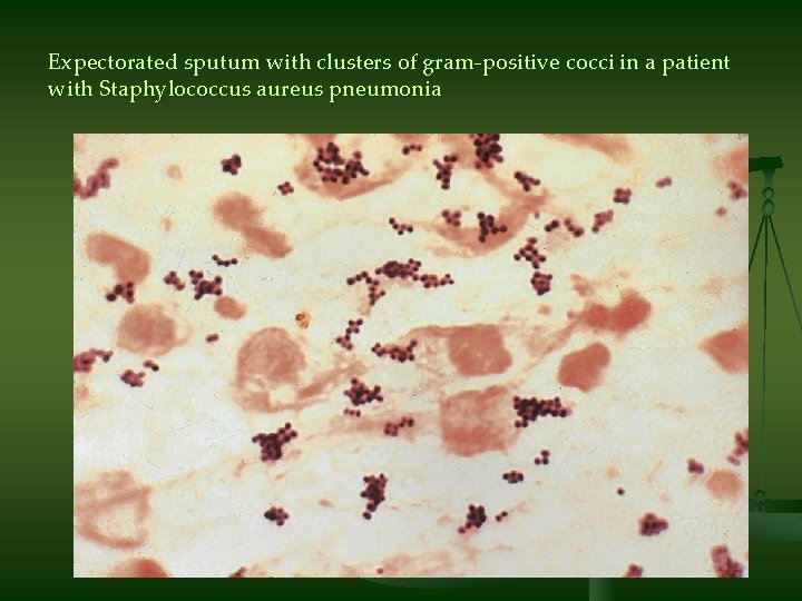 Expectorated sputum with clusters of gram-positive cocci in a patient with Staphylococcus aureus pneumonia