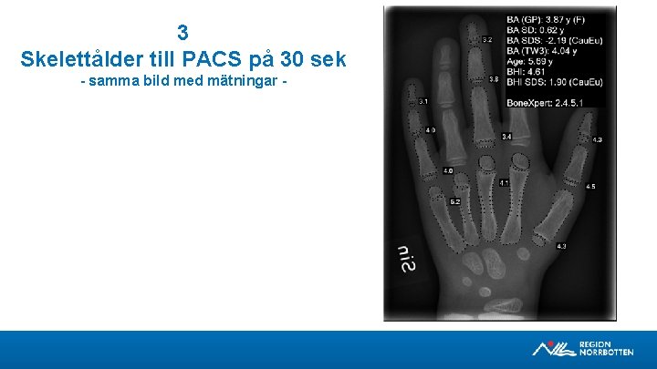 3 Skelettålder till PACS på 30 sek - samma bild med mätningar - 