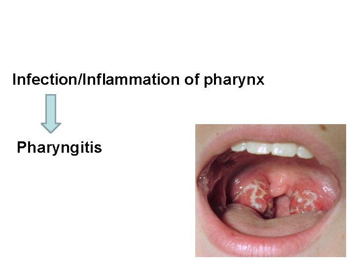 Infection/Inflammation of pharynx Pharyngitis 