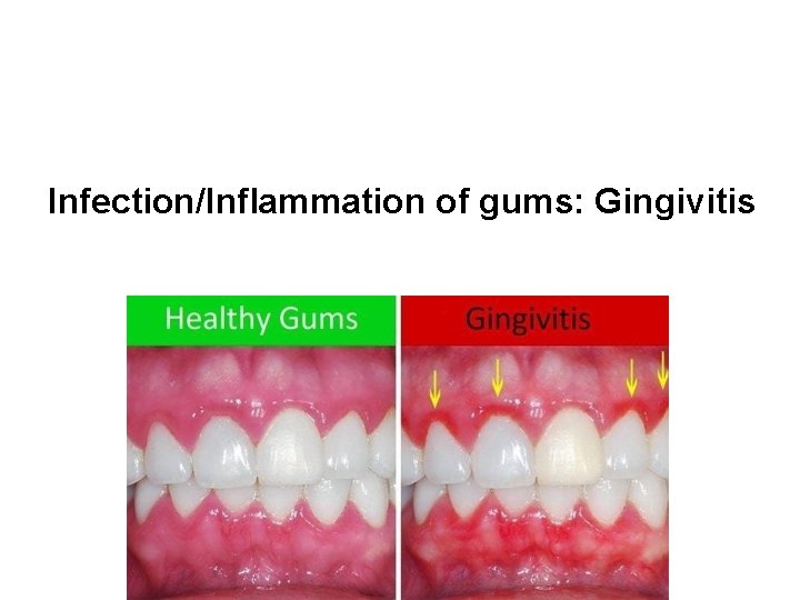 Infection/Inflammation of gums: Gingivitis 