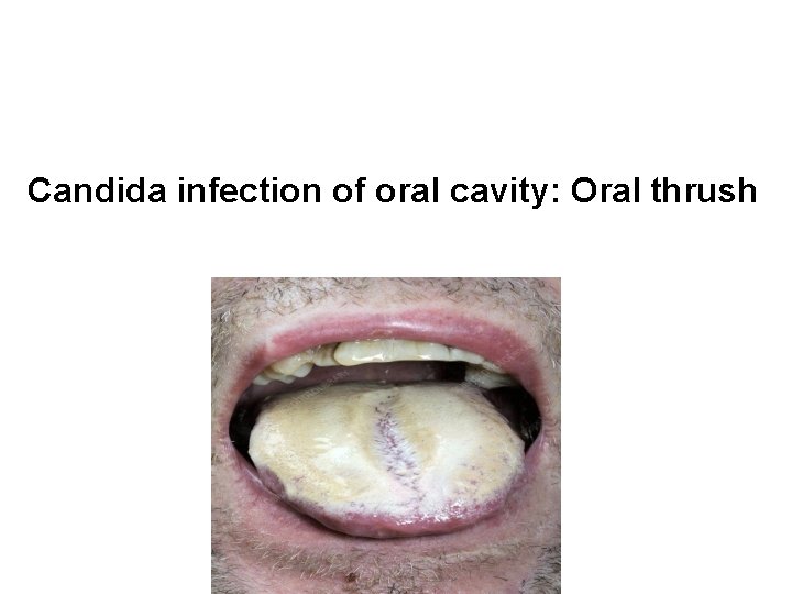 Candida infection of oral cavity: Oral thrush 