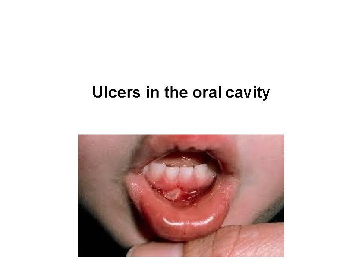 Ulcers in the oral cavity 