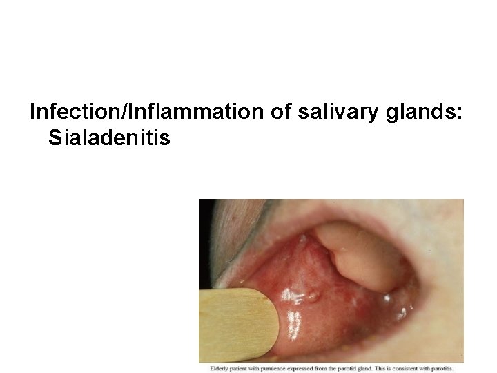 Infection/Inflammation of salivary glands: Sialadenitis 