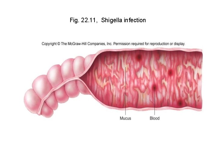 Fig. 22. 11, Shigella infection 