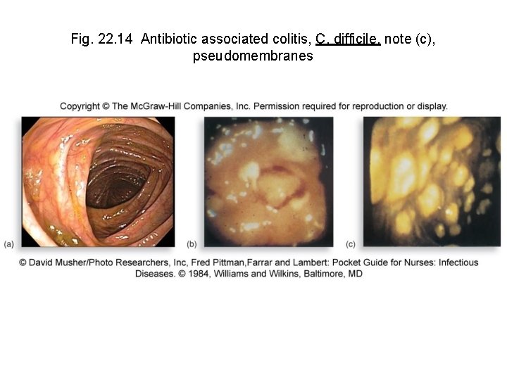 Fig. 22. 14 Antibiotic associated colitis, C. difficile, note (c), pseudomembranes 