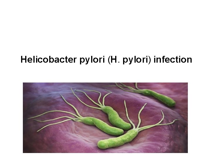 Helicobacter pylori (H. pylori) infection 