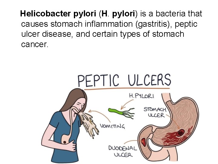 Helicobacter pylori (H. pylori) is a bacteria that causes stomach inflammation (gastritis), peptic ulcer