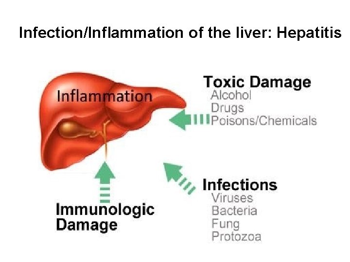 Infection/Inflammation of the liver: Hepatitis 