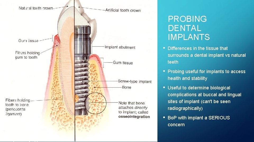 PROBING DENTAL IMPLANTS • Differences in the tissue that surrounds a dental implant vs