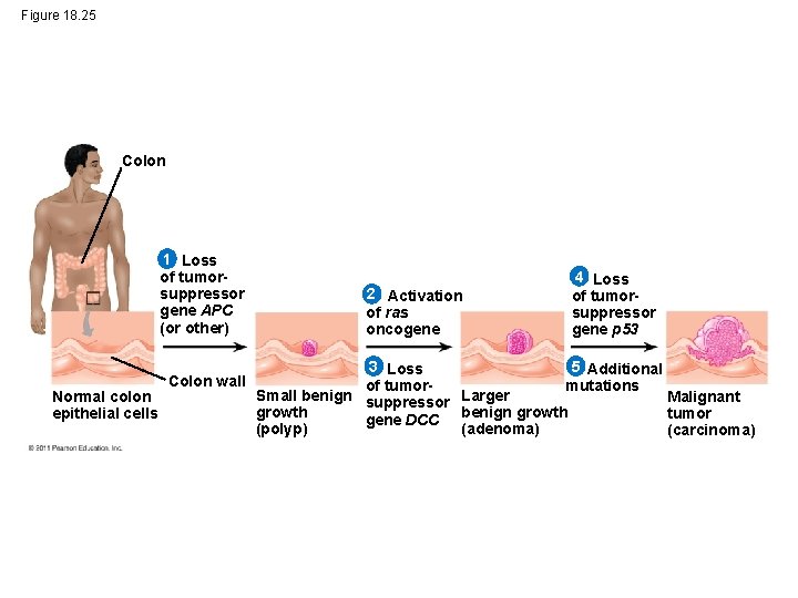 Figure 18. 25 Colon 1 Loss of tumorsuppressor gene APC (or other) Normal colon